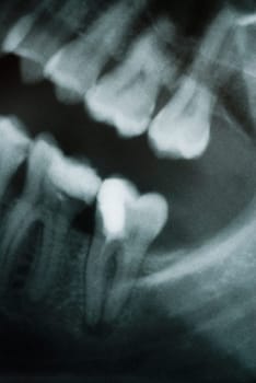 Close_up of a dental X_Ray