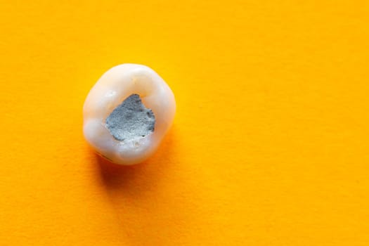 Tooth with a filling close-up on a yellow background