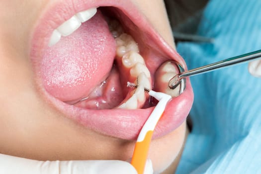 Macro close up of hands doing interdental cleaning on human teeth.Human mouth wide open with interdental brush between teeth.