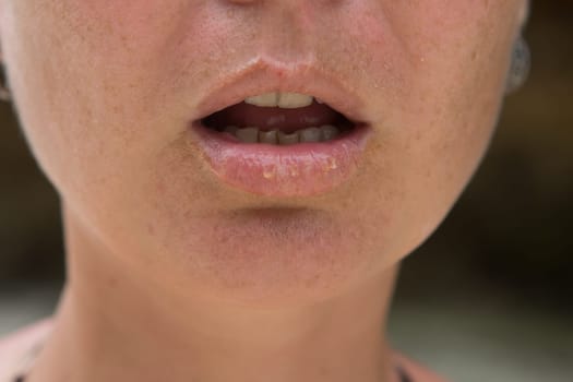 Close-up of female lips suffering from herpes disease