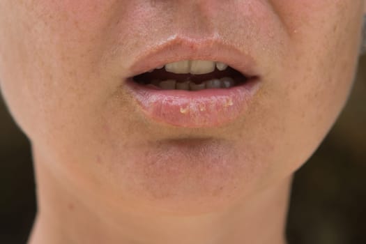 Close-up of female lips suffering from herpes disease