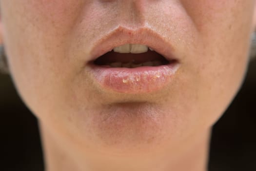 Close-up of female lips suffering from herpes disease