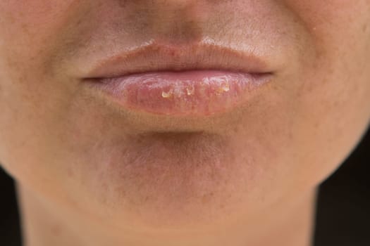 Close-up of female lips suffering from herpes disease