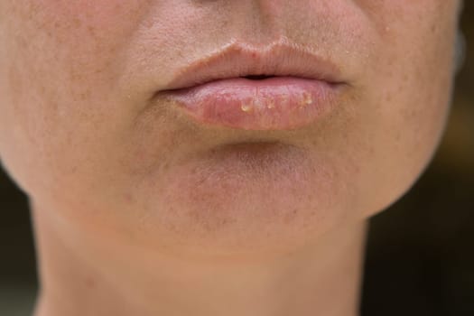 Close-up of female lips suffering from herpes disease