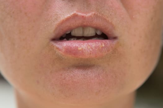 Close-up of female lips suffering from herpes disease