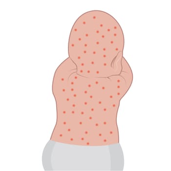 Baby's back affected with eczema skin disease vector illustration Dermatology problem