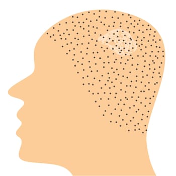 Fungal infection on scalp head vector illustration
