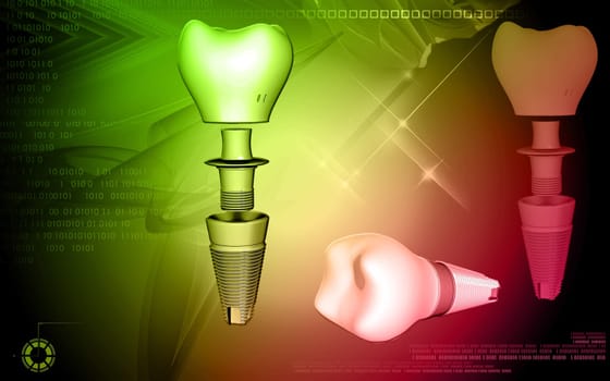 Digital illustration Dental implant in colour background