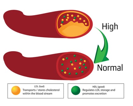Turning high level of atherosclerotic plaque in blood vessel into normal level. medical vector infographics