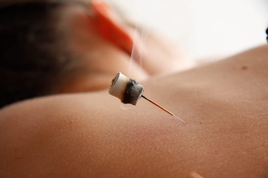 Acupunture cupping is a  Chinese Medicine Procedure
