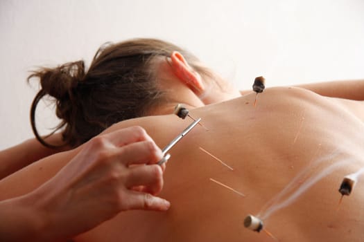 Acupunture cupping is a  Chinese Medicine Procedure