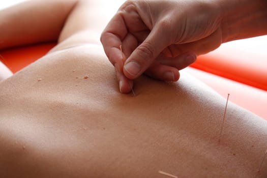 Acupunture cupping is a  Chinese Medicine Procedure