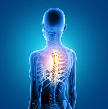 3D render of a female medical figure with spine highlighted