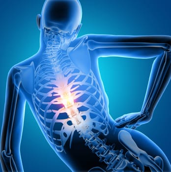 3D render of a female medical figure with spine highlighted in pain