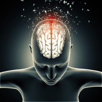 3D render of a female medical figure with brain disintegrating