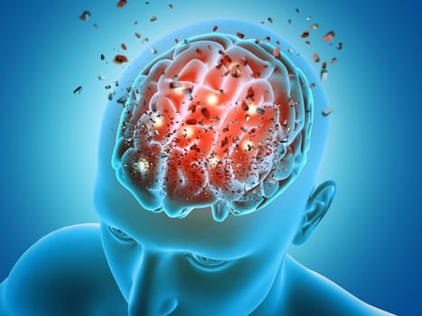 3D render of a male figure with brain parts  shattering depicting mental health issues