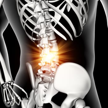 3D render of a male medical figure with lower spine highlighted
