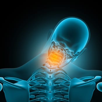 3D render of a male medical figure with neck bones highlighted in pain