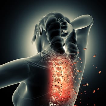 3D render of a medical background with female figure with spine shattering