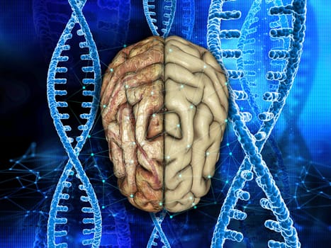 3D render of a medical background with healthy and unhealthy brain on DNA strands