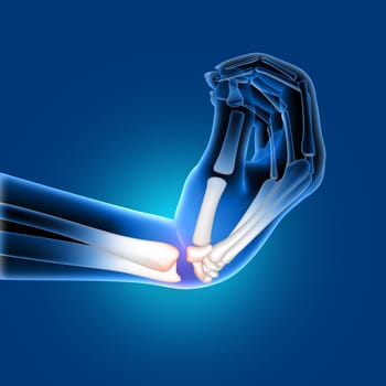 3D render of a medical image of a painful bent wrist
