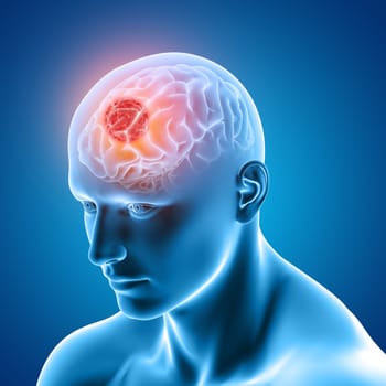 3D render of a medical image showing male figure with brain tumour