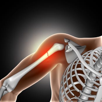3D render of a medical image showing broken bone in arm
