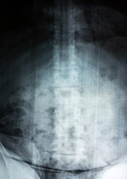 Film X-ray of spine a person, Film grain style