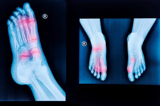 X-ray of human feet. Normal radiography of the foot, medical diagnostics, traumatology and orthopedics