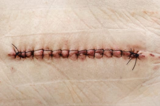 SuPostoperative healing suture on human skin with black medical threads rgery on the hip. Postoperative suture on the skin with iodine. Un Stitched up skin after an operation