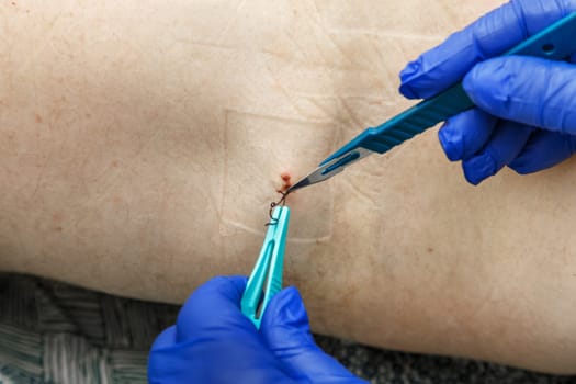 Removal of threads from the postoperative suture with tweezers by a medical professional. Close-up. Gloved hands