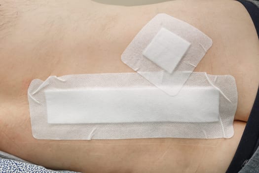 Postoperative suture sealed with a plaster after spinal surgery