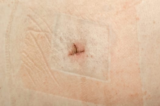Healing suture scar after small surgery on human skin