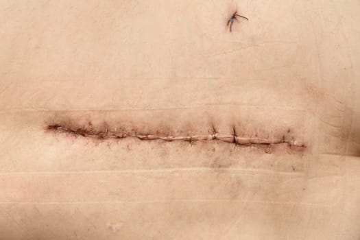 Surgery on the hip. Postoperative suture on the skin with iodine. Un Stitched up skin after an operation
