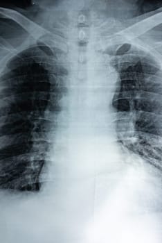 Film X-ray of breast a person, Film grain style