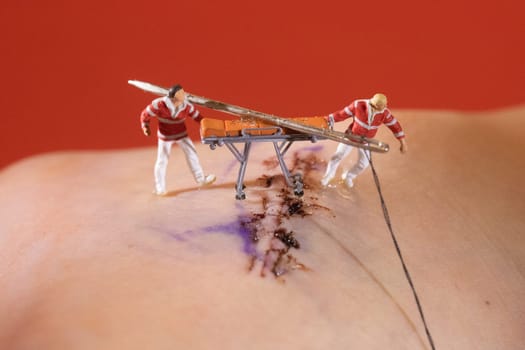 Surgery Stitches Being Handles by Miniature HO Scale Figures