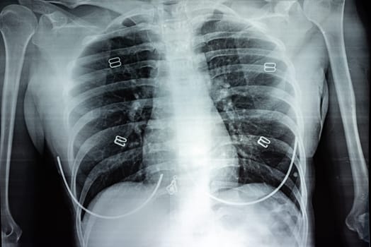 Film X-ray of breast a person, Film grain style