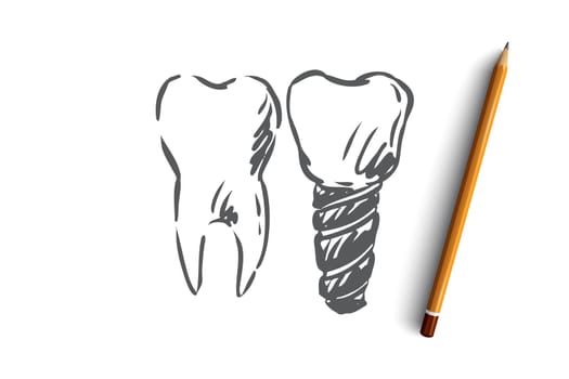 Implant, dental, tooth, health, care concept. Hand drawn healthy tooth and implant concept sketch. Isolated vector illustration.