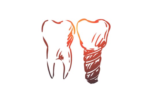 Implant, dental, tooth, health, care concept. Hand drawn healthy tooth and implant concept sketch. Isolated vector illustration.