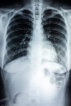 Film X-ray of breast a person, Film grain style