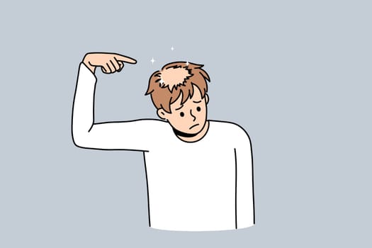 Unhappy young man point at bald head suffer from alopecia problems. Upset stressed guy struggle with hair loss need medical treatment. Haircare and aging concept. Flat vector illustration.