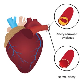 Cholesterol level in blood vessel vector illustration