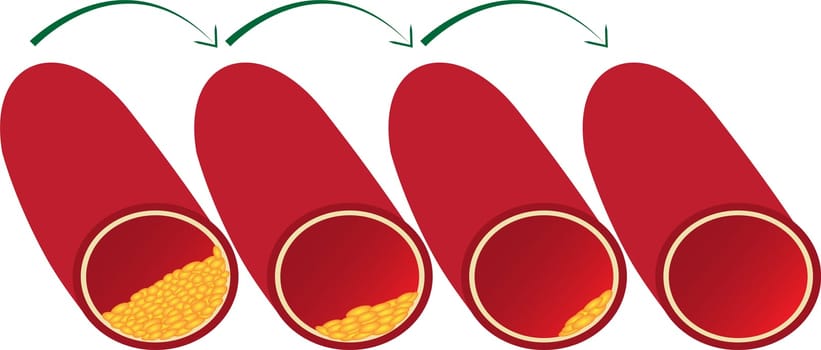 Clean up and redusing vessel blood from atherosclerotic plaque vector illustration