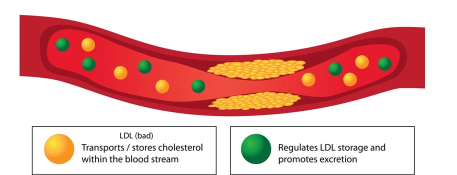 Atherosclerotic plaque in blood vessel and good and bad lipids vector infographics