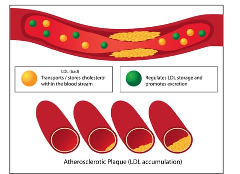 Role of good and bad lipids and levels of atherosclerotic plaque in blood vessel medical vector infographics
