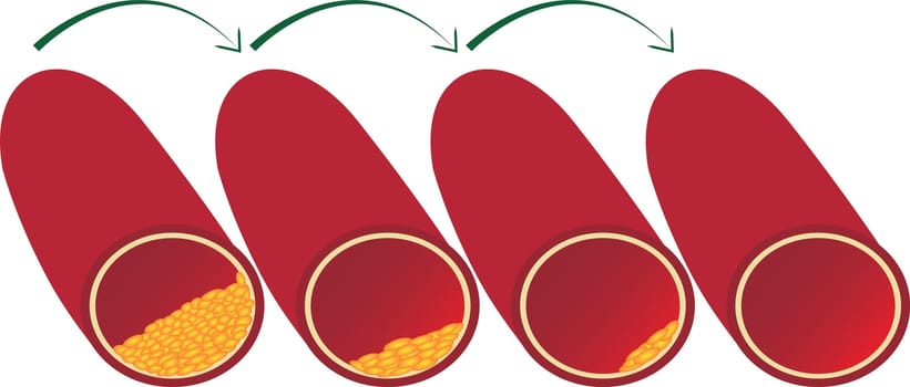 Clean up and redusing vessel blood from atherosclerotic plaque vector illustration