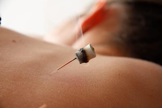 woman relaxes from acupuncture procedure. An acupuncturist doong acupuncture very accurately. Traditional chinese medicine