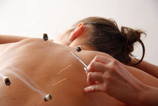 woman relaxes from acupuncture procedure. An acupuncturist doong acupuncture very accurately. Traditional chinese medicine