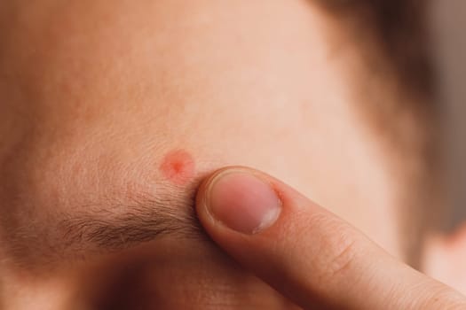 Pimple on the man's forehead above eyebrow. Designated by color close-up