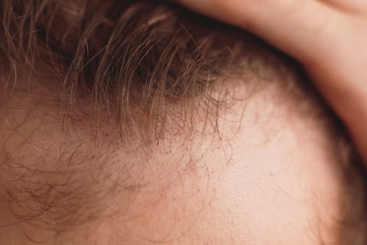 balding man is opening his forehead, close up view